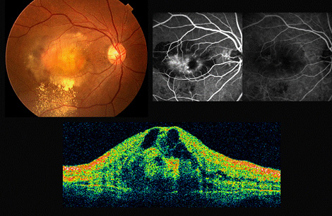 加齢黄斑変性（上左）の蛍光眼底造影（上中右）と断層像（下）