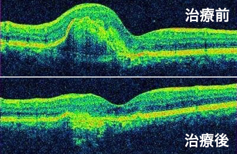 抗VEGF薬による加齢黄斑変性の治療