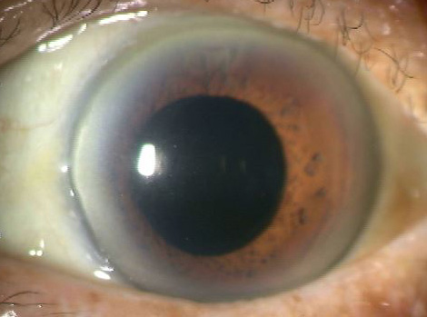 白内障手術後の人工レンズ挿入眼